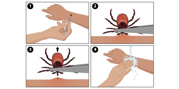 Tick remove